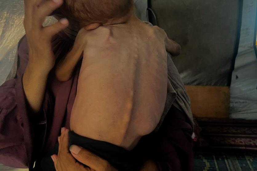 طفل يعاني من سوء تغذية في غزة