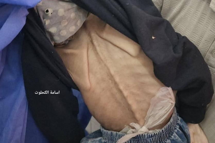 المجاعة تواصل حصد الضحايا في غزة