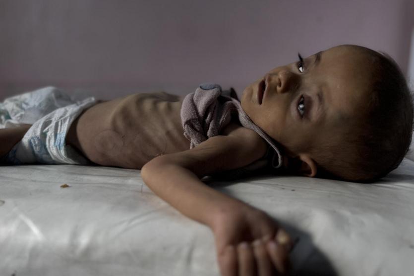 طفل يعاني من سوء تغذية في غزة