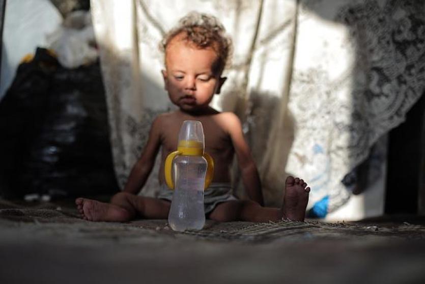 طفل يعاني من سوء تغذية في غزة - ارشيف