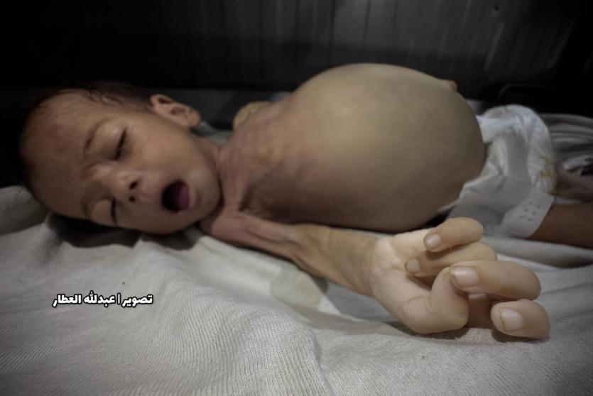 وفاة طفل جراء الجوع في غزة