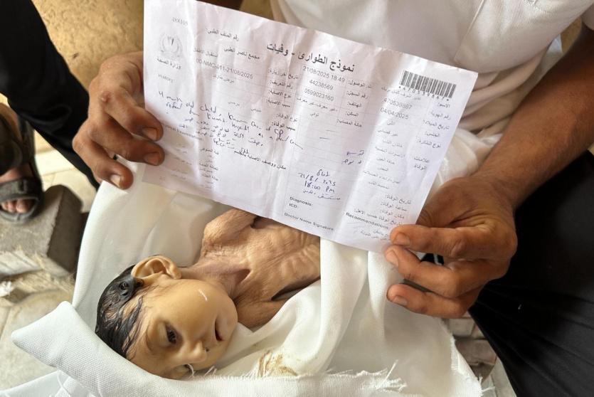 طفلة شهيدة بسبب سوء التغذية في غزة -ارشيف-